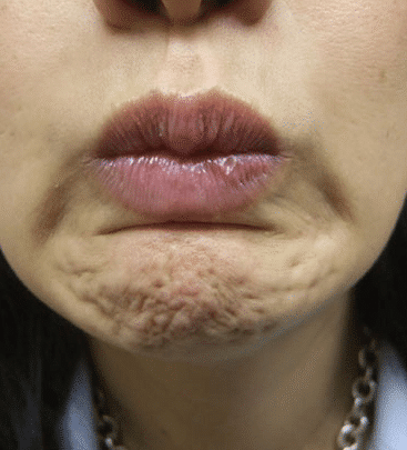 botox for pebbled dimpled chin