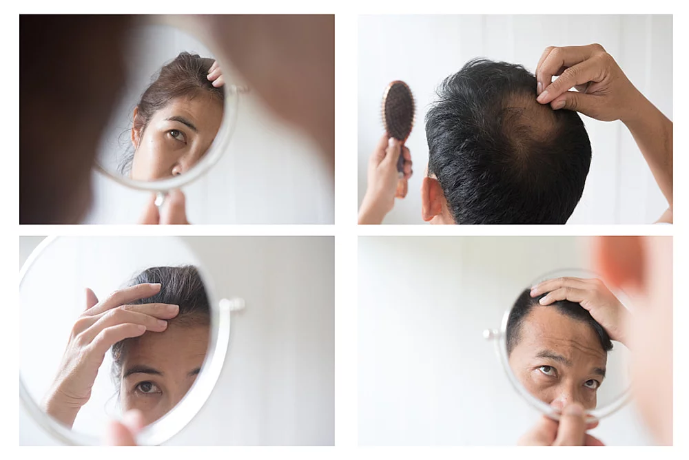 types of hair loss