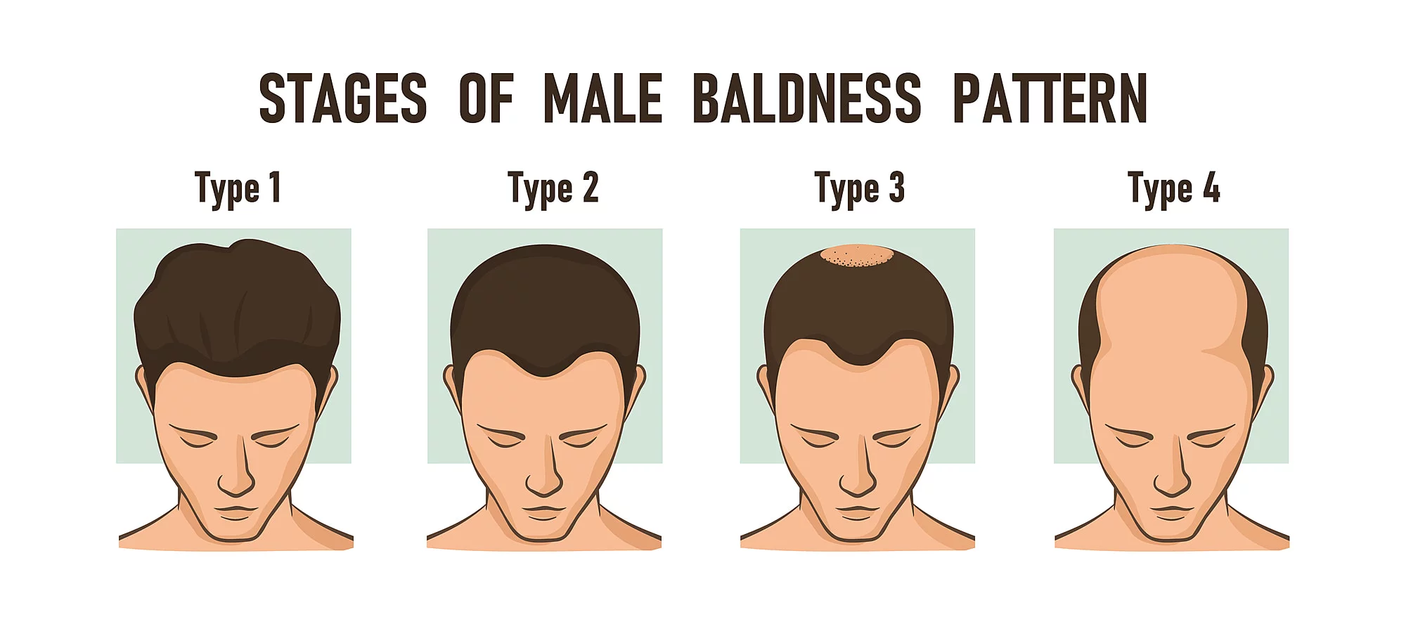 Male Pattern Hair Loss