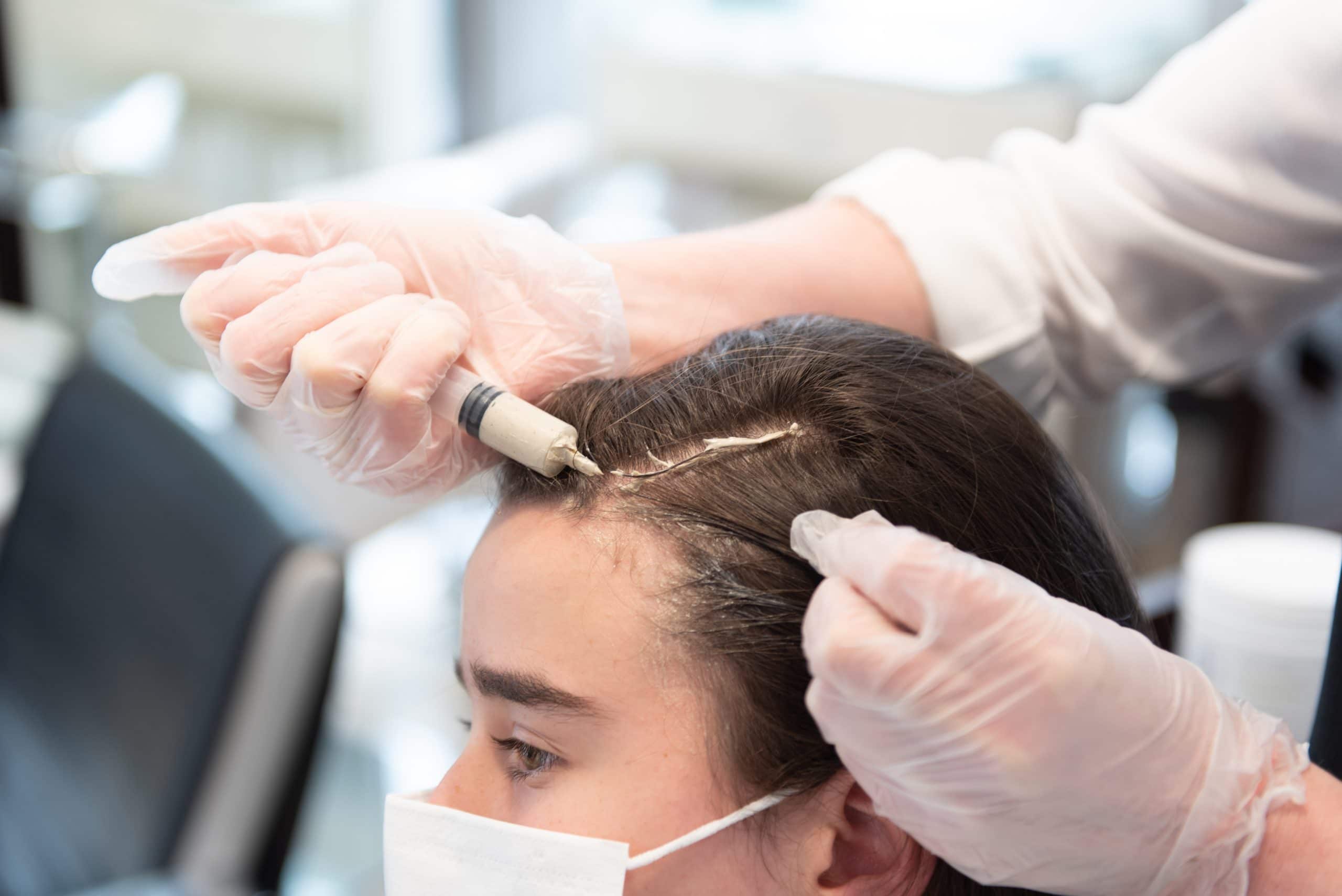 teenage hair loss treatment