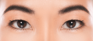 HIFU Treatment - Fotona Vector Lift Singapore (Fotona 4D 5D 6D Laser)