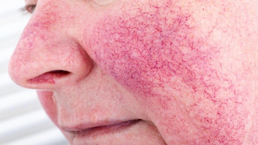 Erythematotelangiectatic rosacea (ETR)
