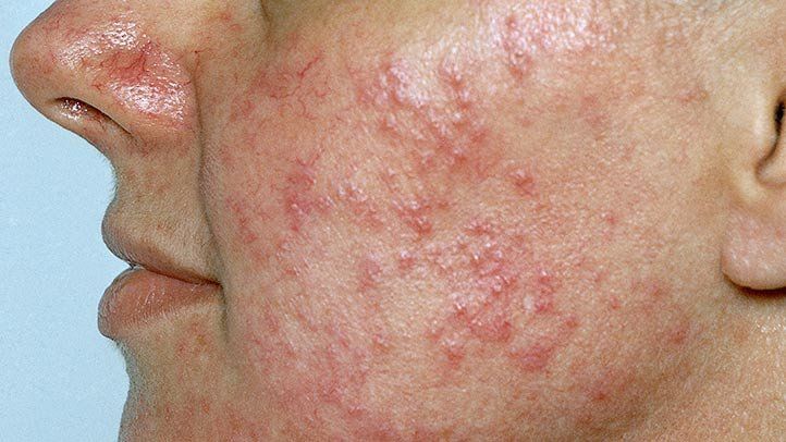 Inflammatory Rosacea (Papulopustular)