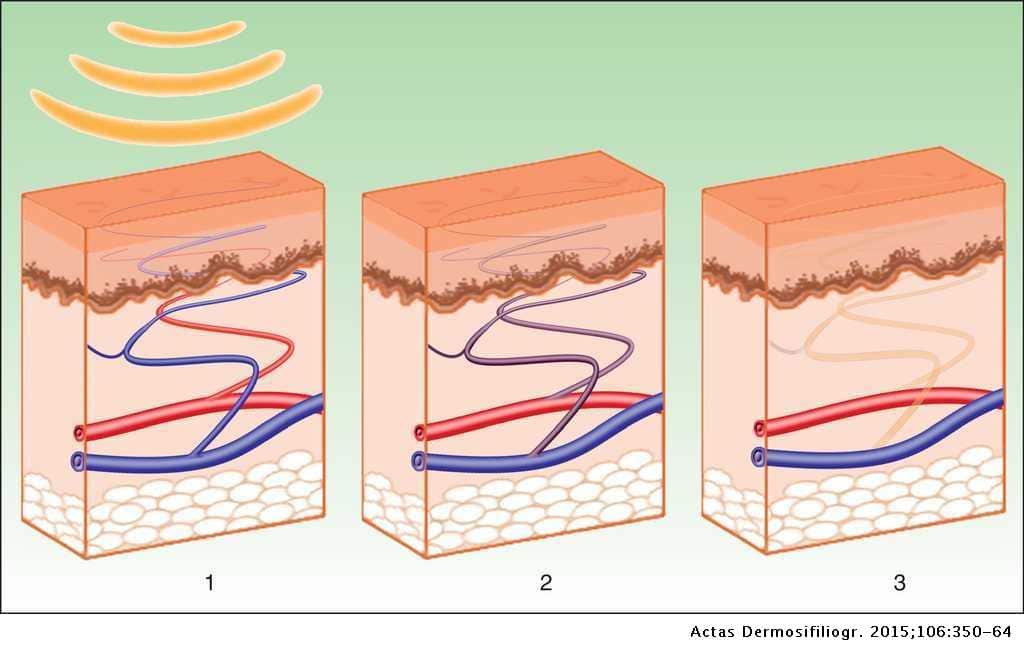 Laser Treatment
