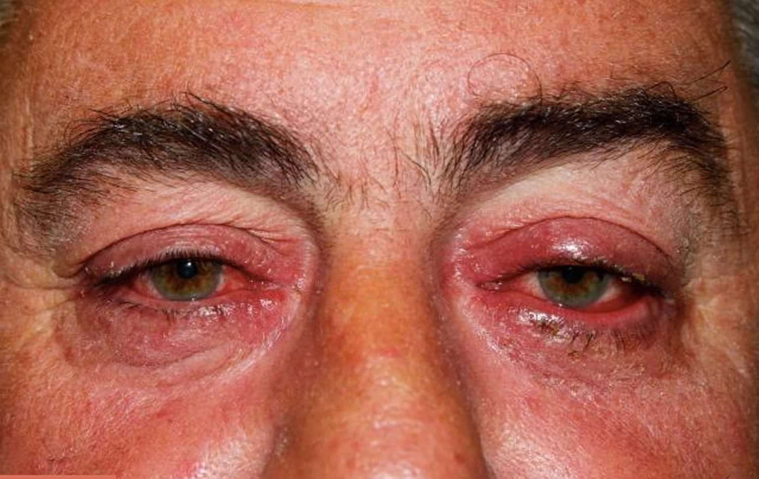 Ocular Rosacea