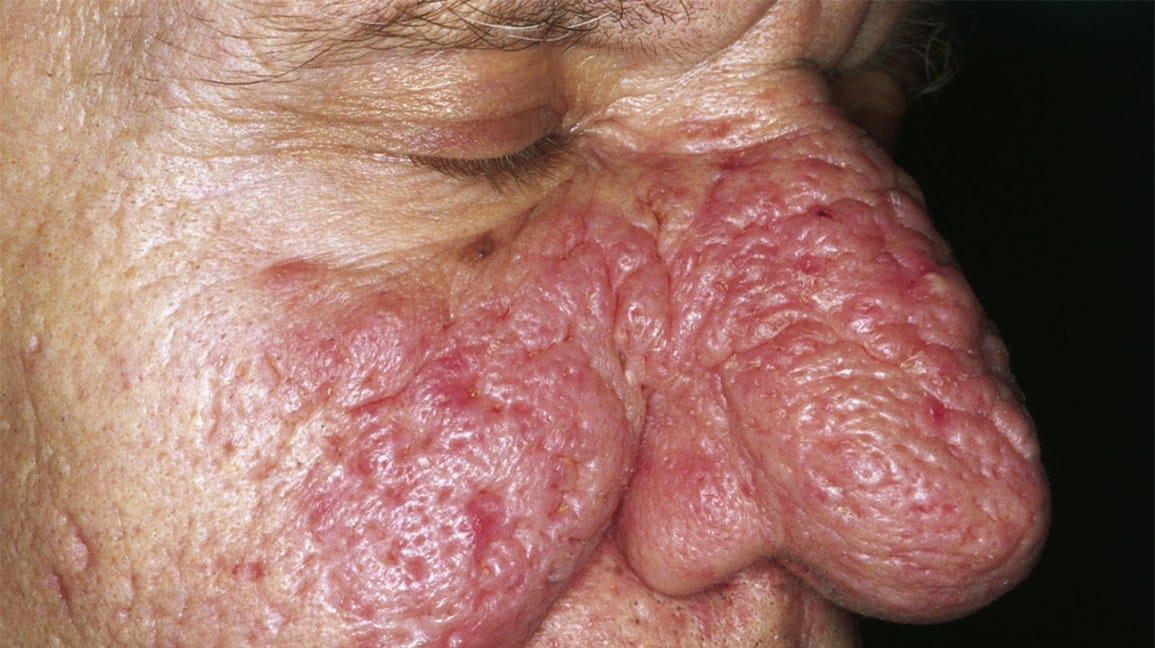 Phymatous Rosacea