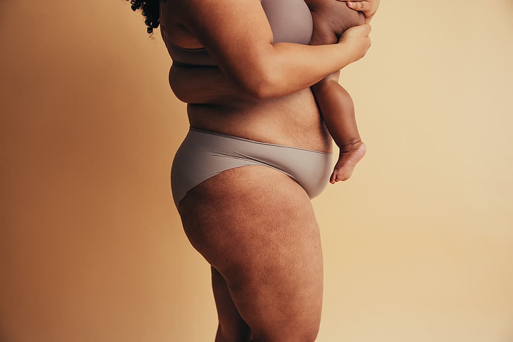 Should You Get Liposuction After Pregnancy