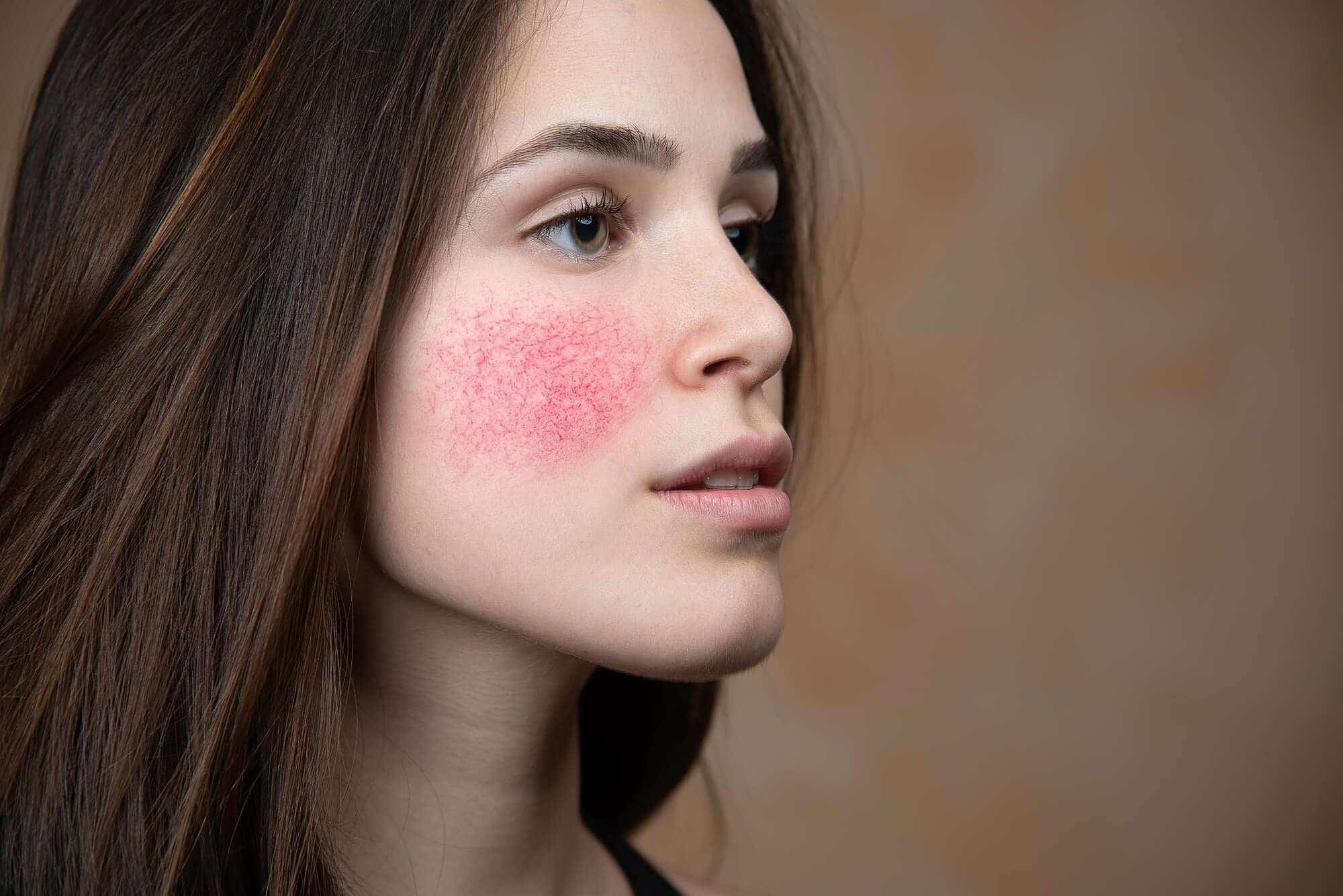 5 Common Rosacea Triggers And How To Soothe Them