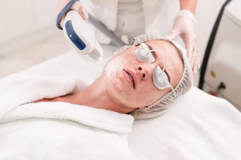 How Pico Laser Helps Remove Permanent Acne Scars