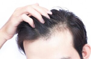 Male & Female Hair Loss Treatment Singapore