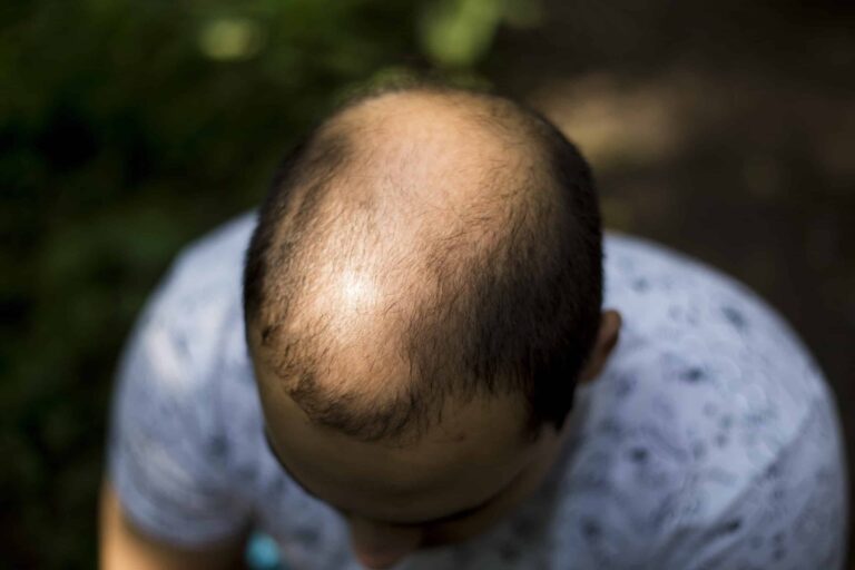 FUE hair transplant