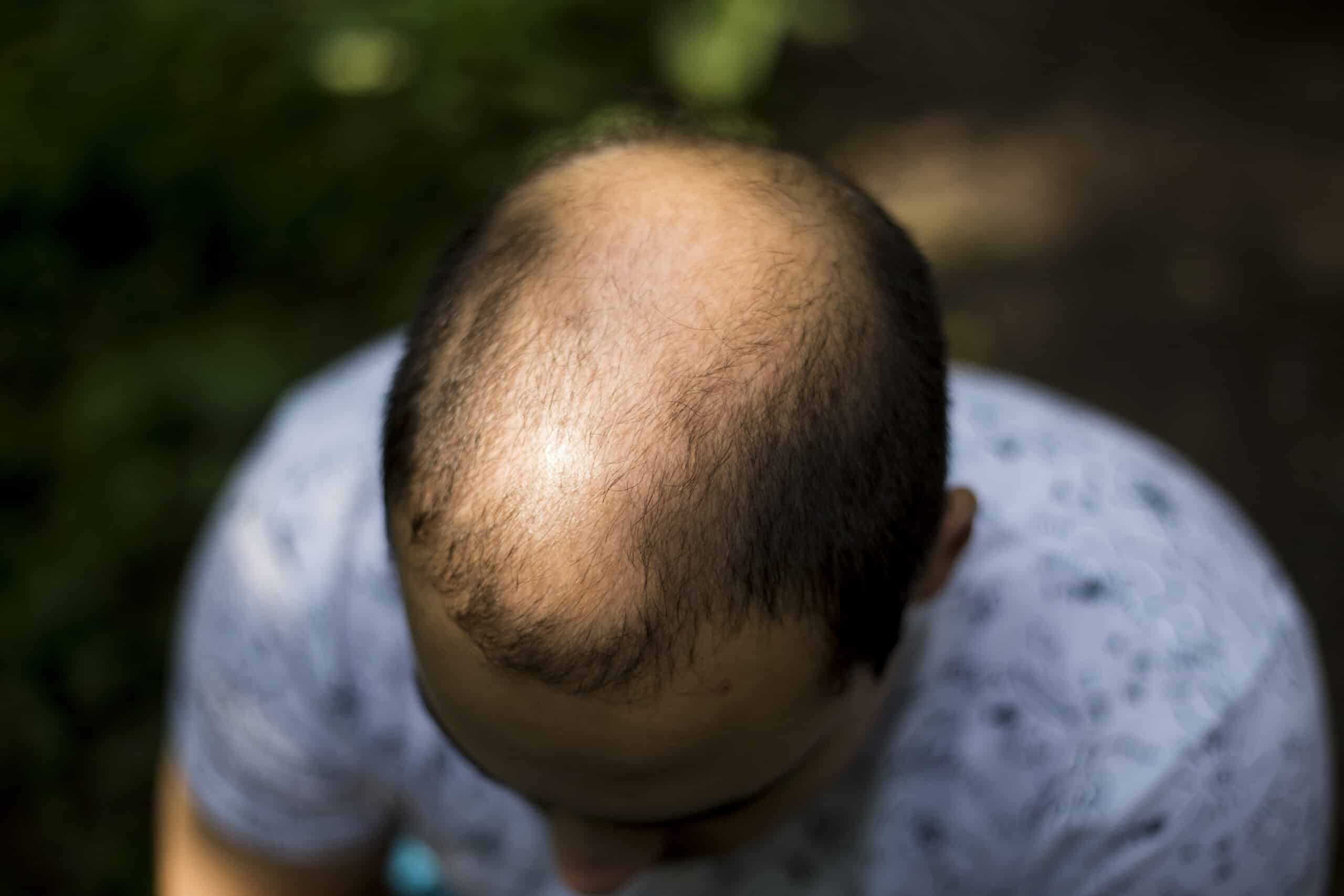 FUE hair transplant
