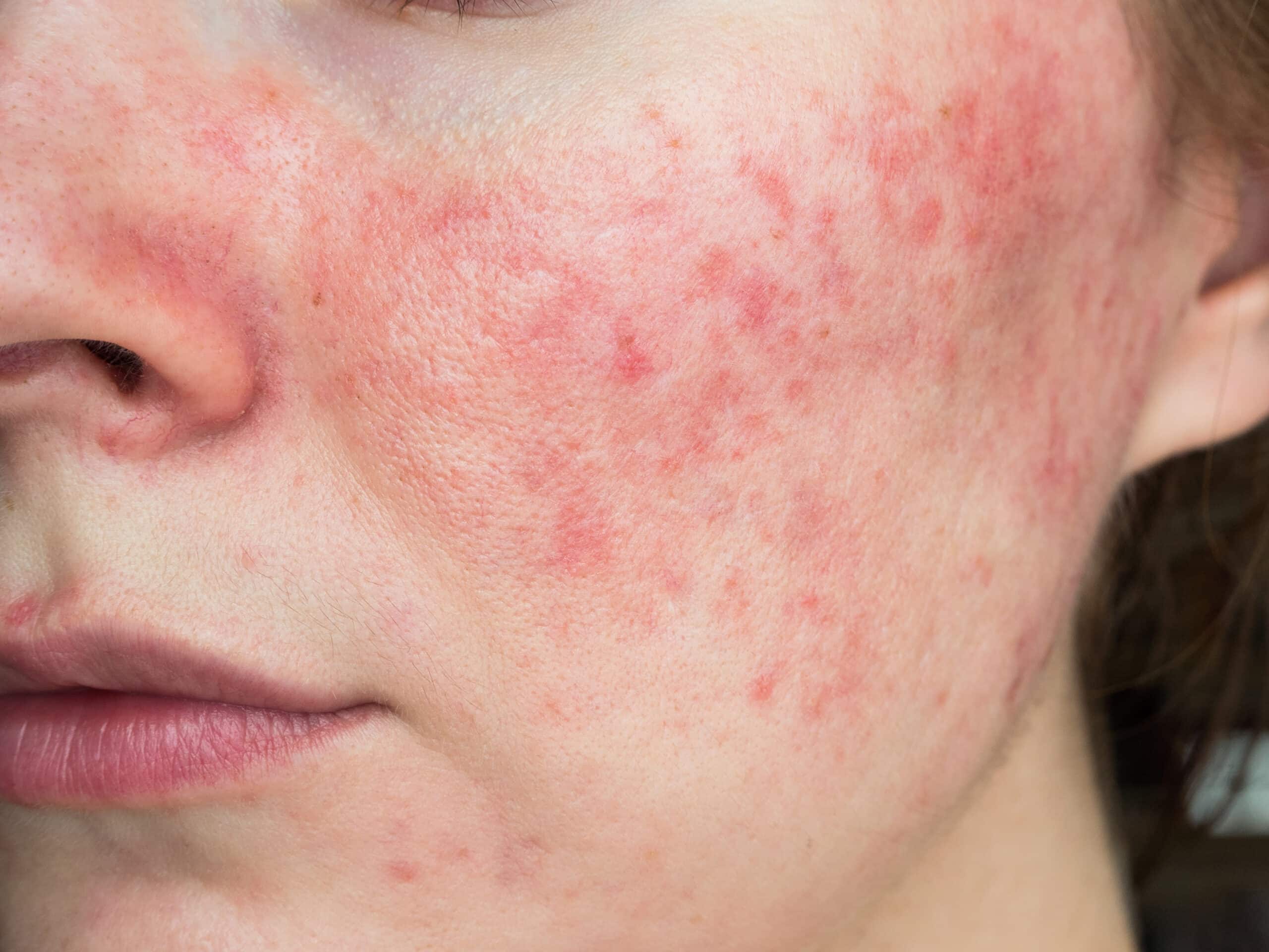 Looking into Rosacea and Vitamin Deficiency