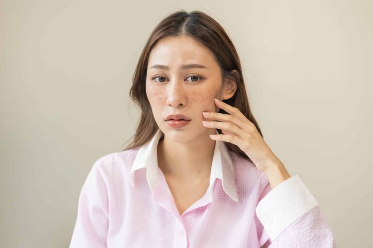 How Oral Tranexamic Acid Helps to treat Melasma