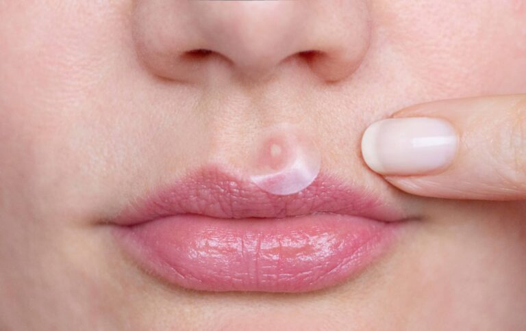 Do Acne Patches Cause Or Treat Acne Scars