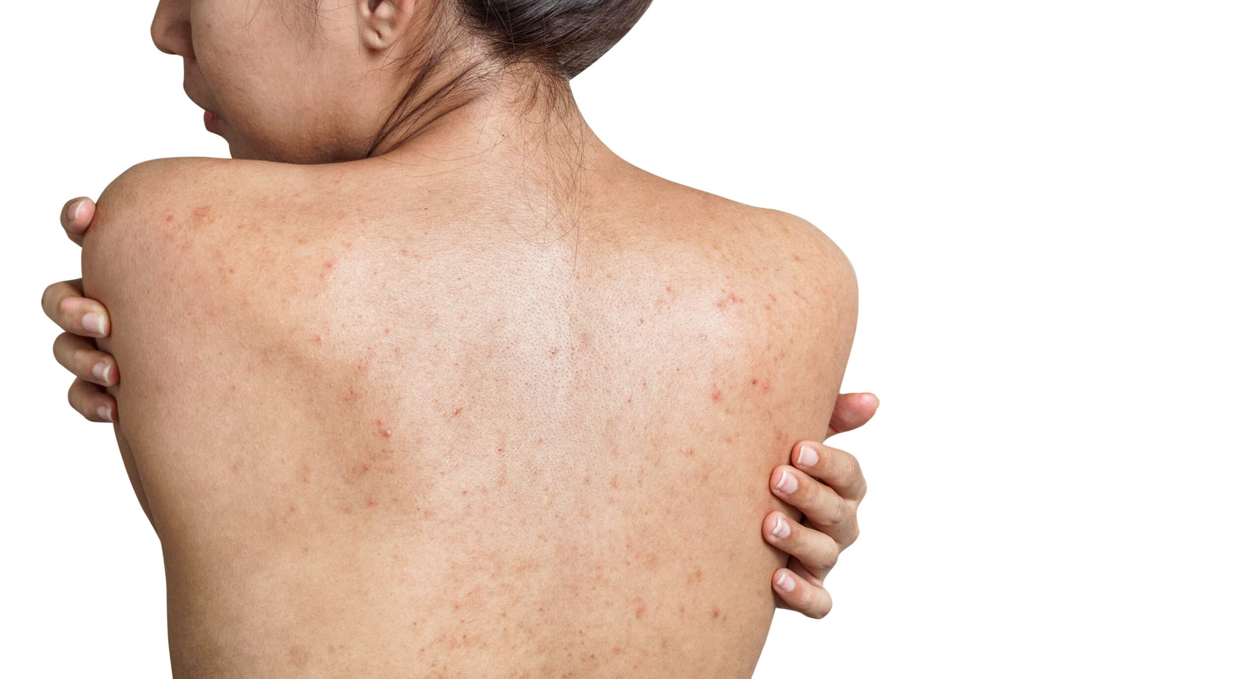 Truncal Acne Singapore