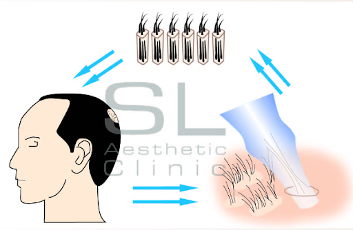 SL Aesthetic Clinic Fue Hair Transplant