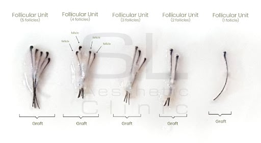 FUE Hair Transplant Singapore