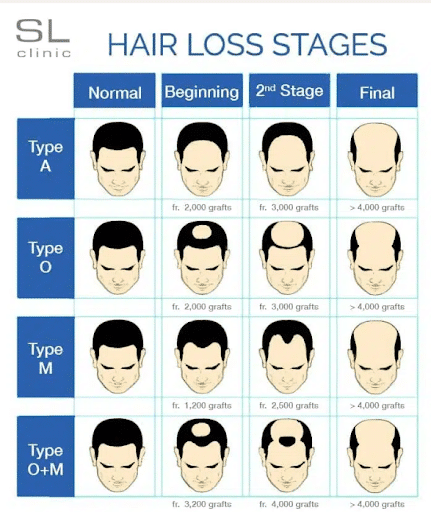 Hair Loss Stages - SL Aesthetics Diagram