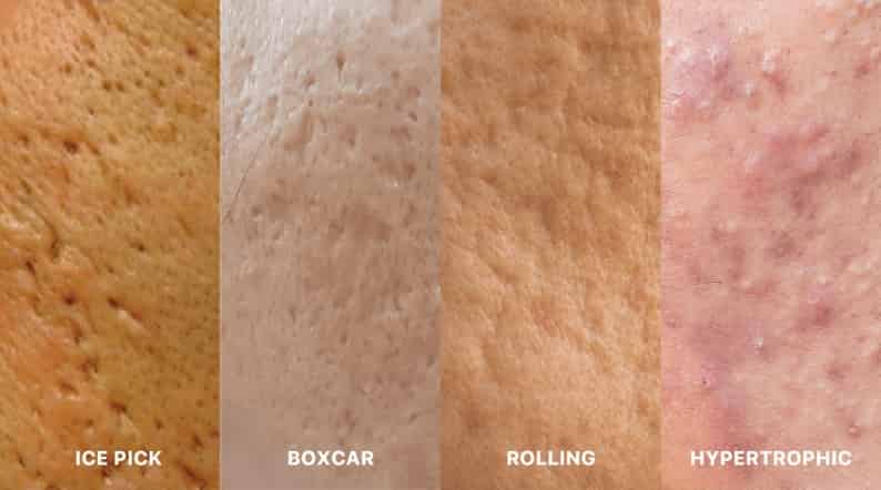 Acne-scars-The-different-types-of-scars-and-how-to-treat-them-min