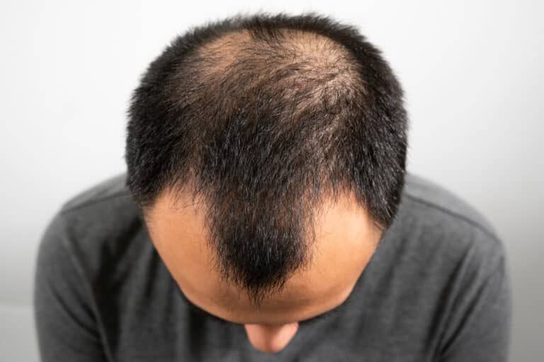 hair loss singapore