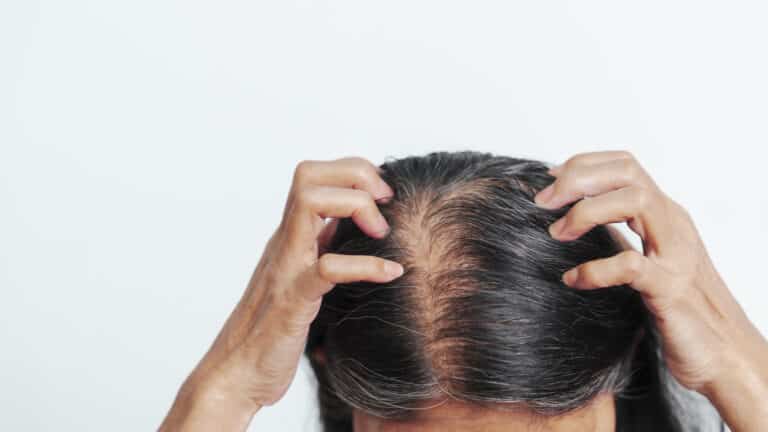 Hair Loss for Women