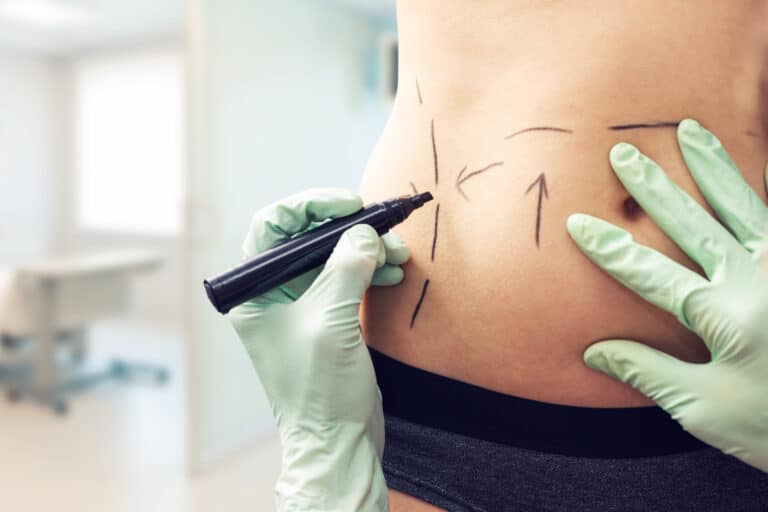 Liposuction Downtime Singapore