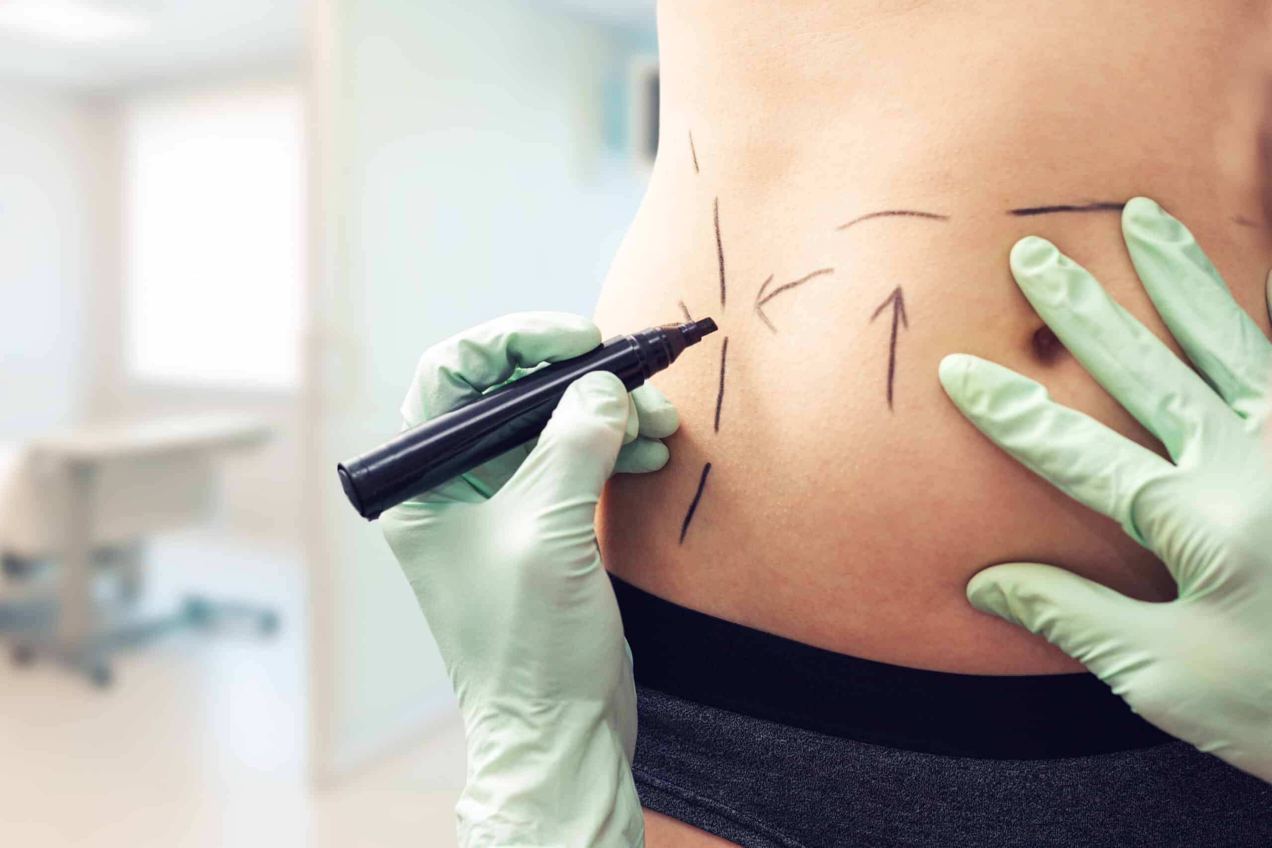 Liposuction Downtime Singapore