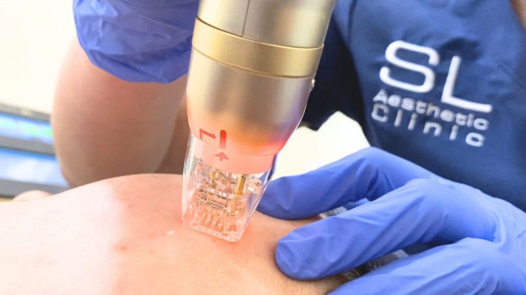 SL Aesthetic Laser Treatment
