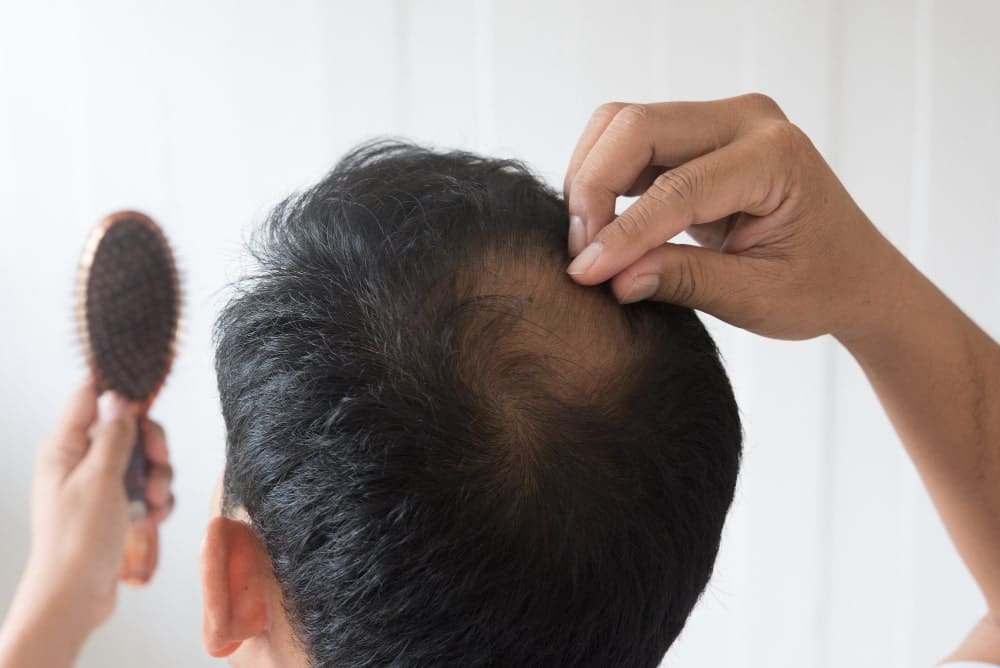 Men Worried About Hair Loss