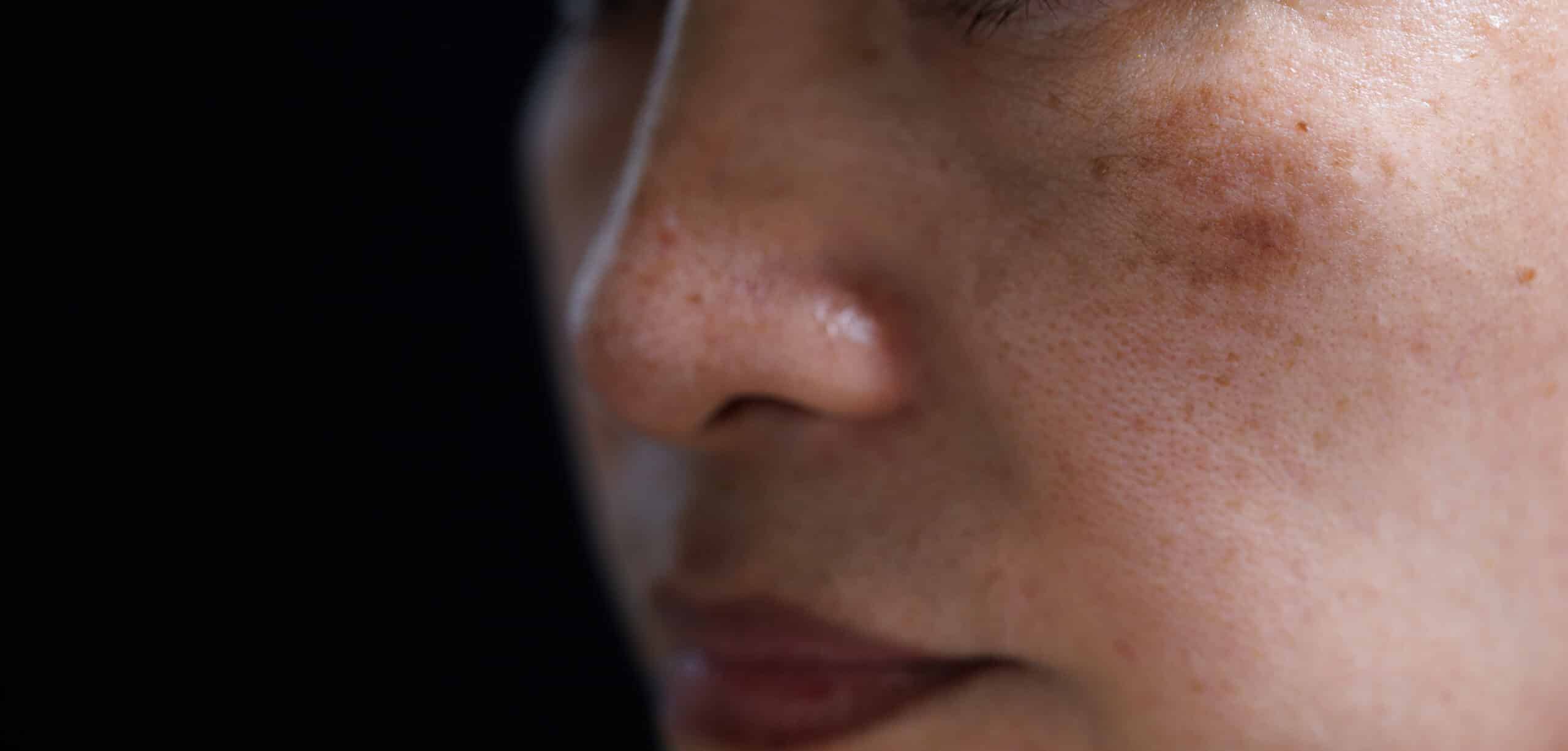 melasma on woman face.