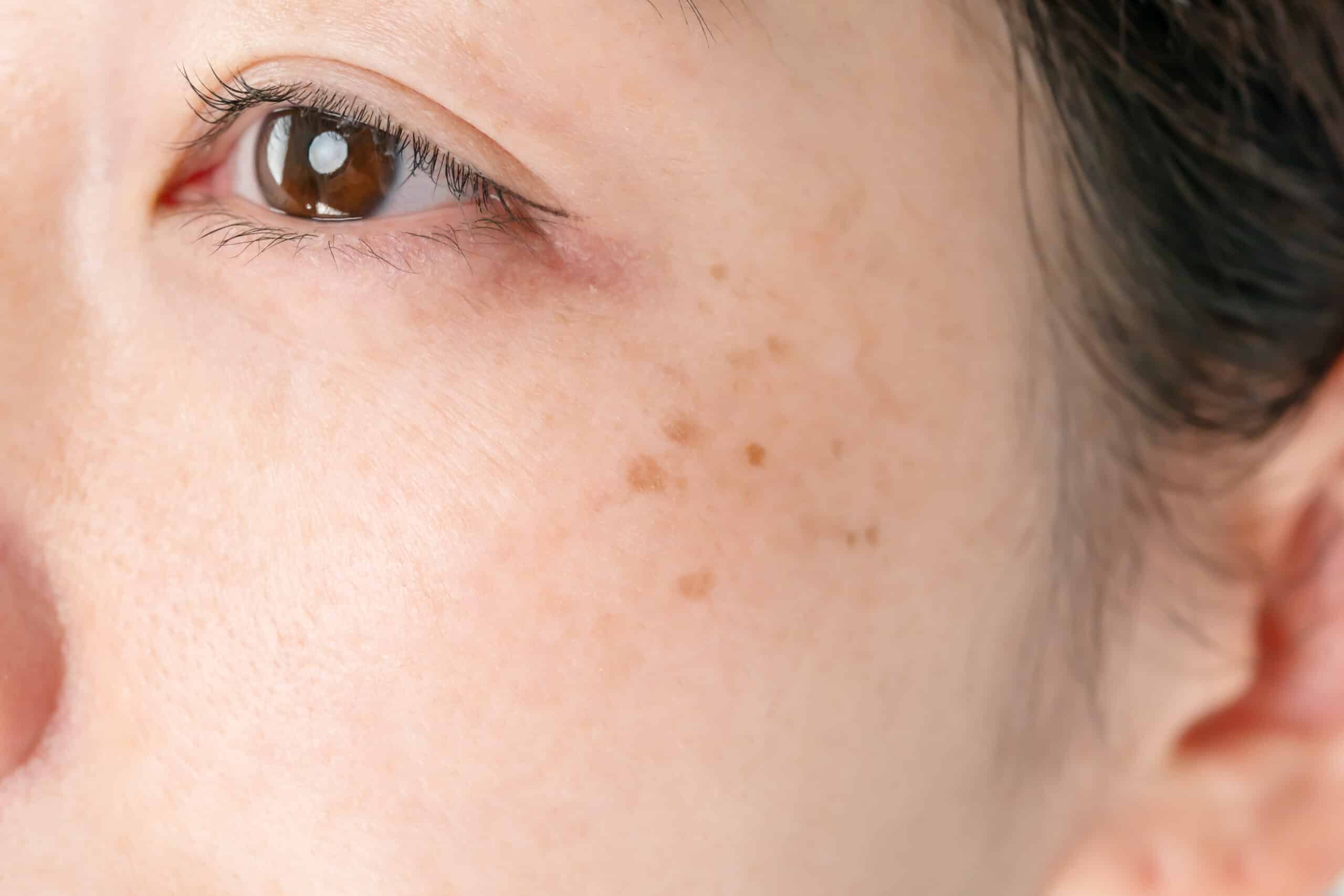 pigmentation removal treatment singapore