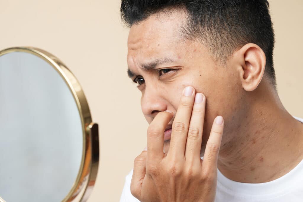 Acne in Acne Scars Mark