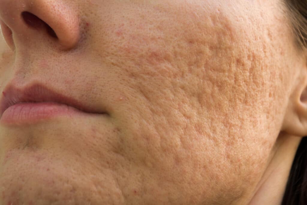 Laser Treatments for Acne Scars - Is it Bad