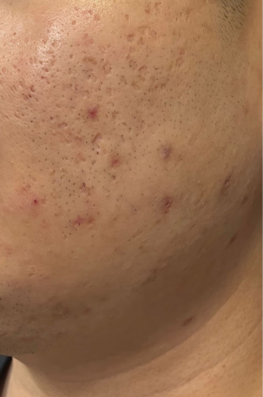 Mix of boxcar and icepick scars