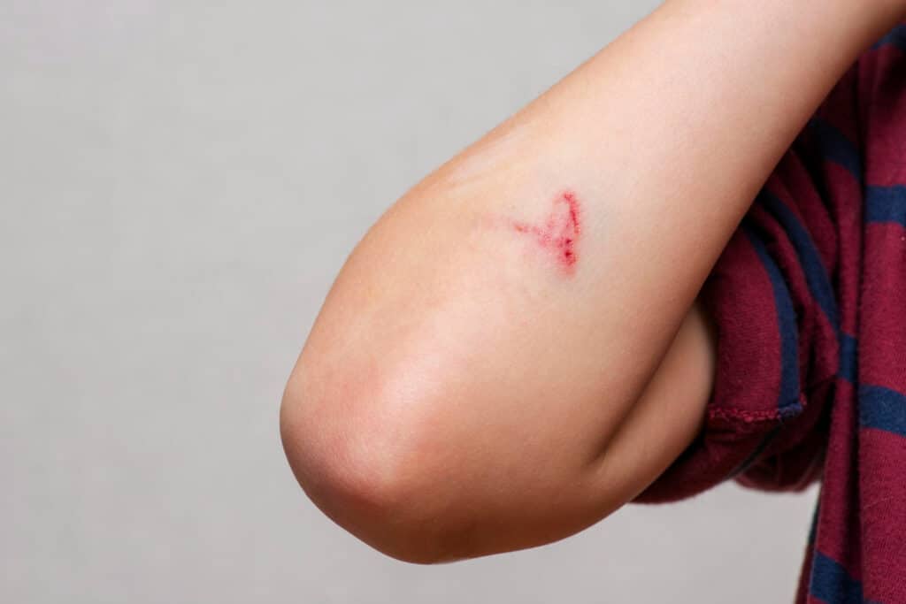 Bruise Laser Removal Treatment After Fillers