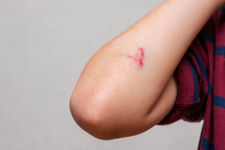 Bruise Laser Removal Treatment After Fillers