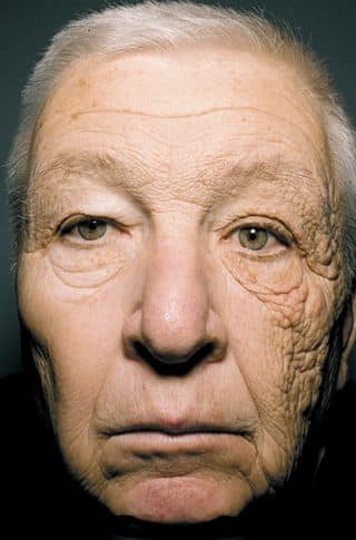 Damage Skin Cancer