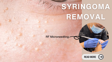 Syringoma Removal Options Singapore