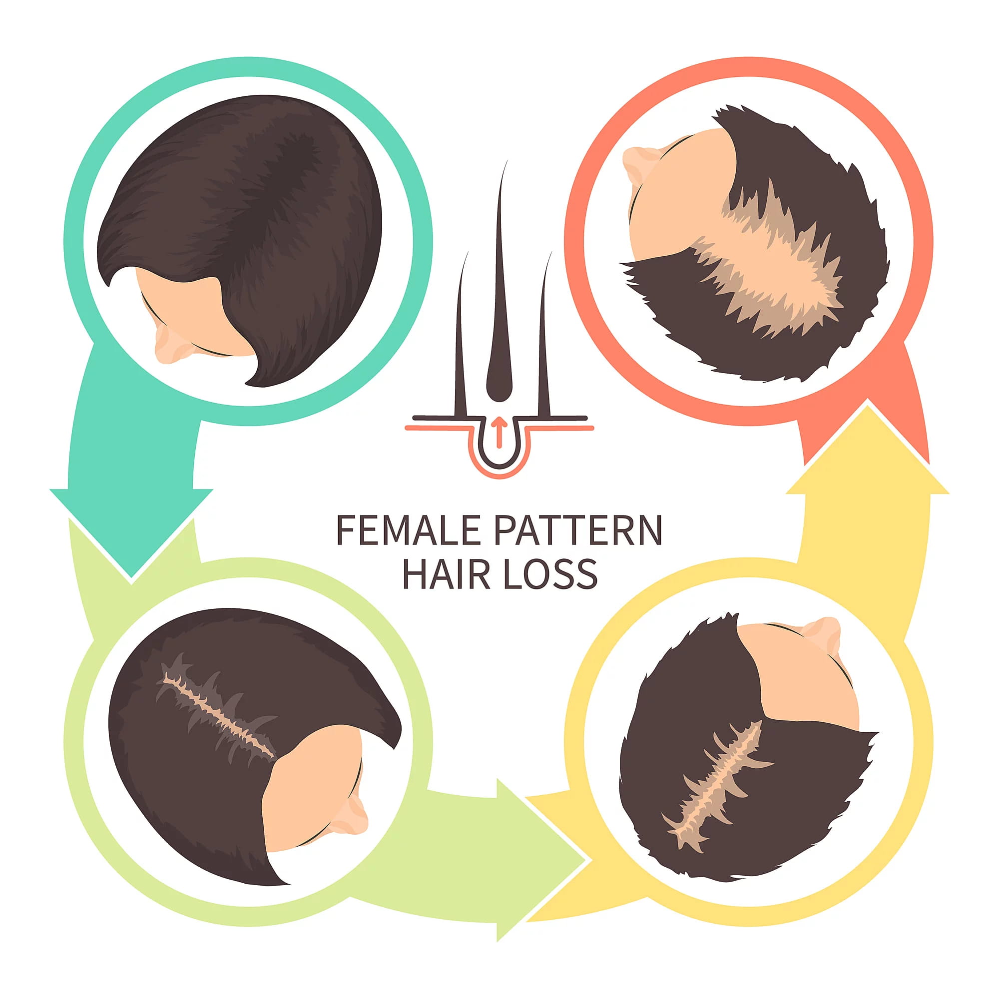 female pattern hair loss