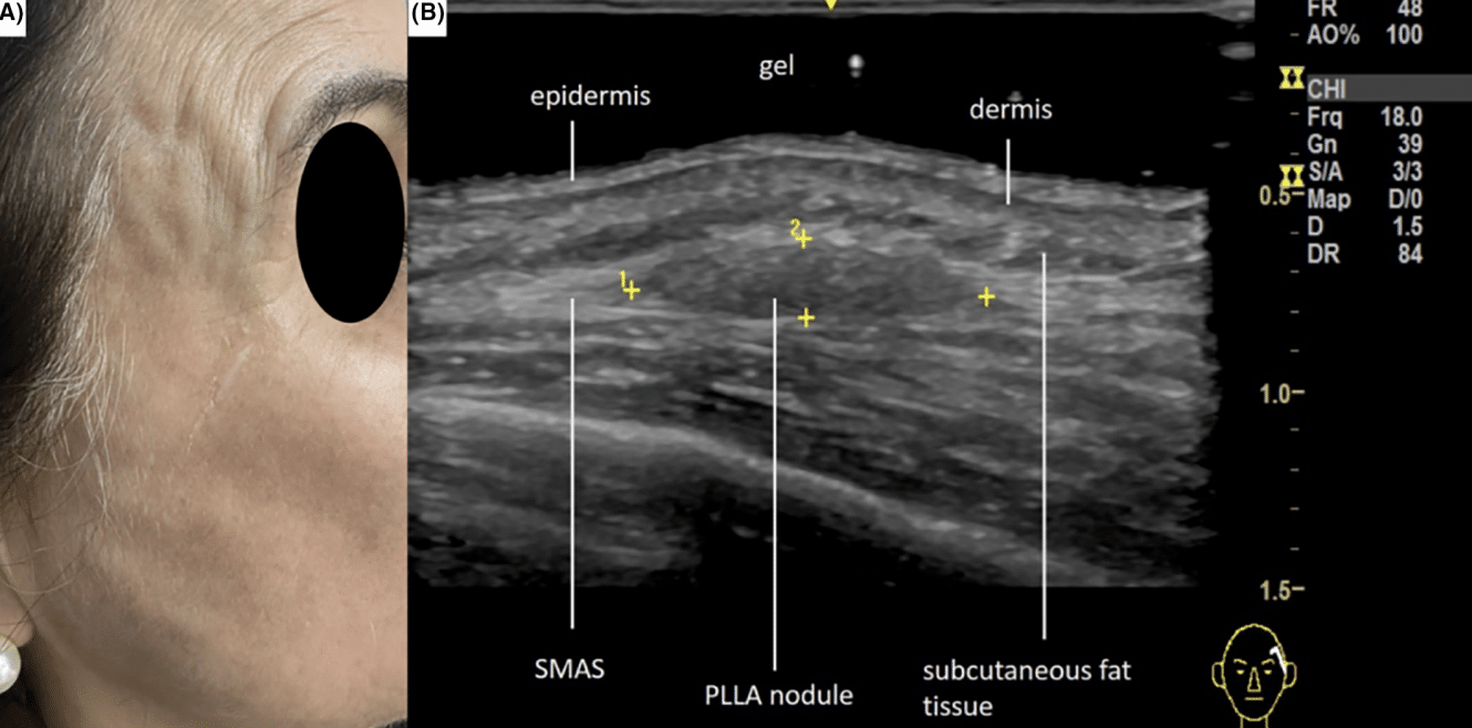 Side Effects of PDLLA Injections Like Juvelook Templ