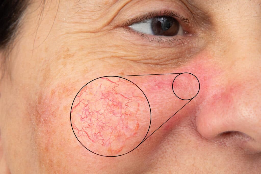Skinoren Azelaic Acid Skin Health Solution