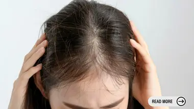 Oral Minoxidil vs Topical Minoxidil to Treat Hair Loss